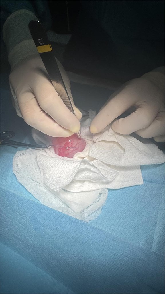Cistotomía para extracción de urolitos