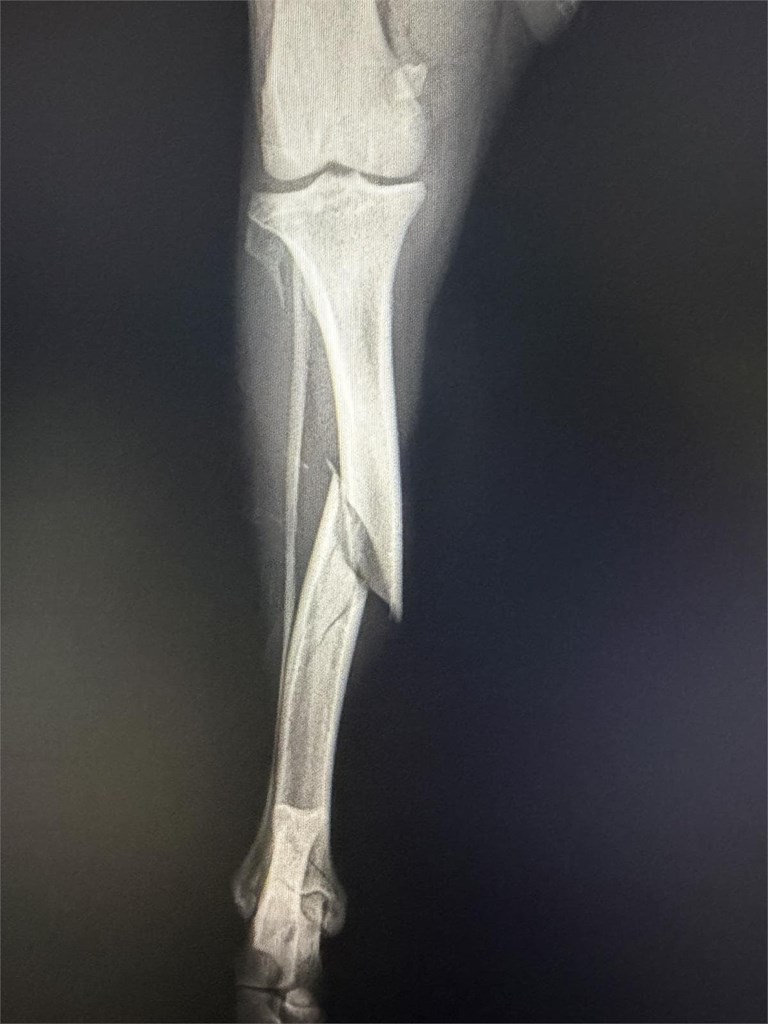 Fractura de tibia y peroné
