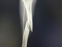 Fractura de tibia y peroné