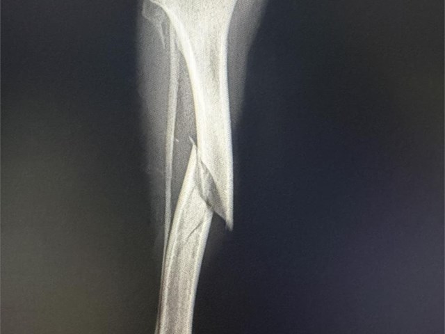 Fractura de tibia y peroné