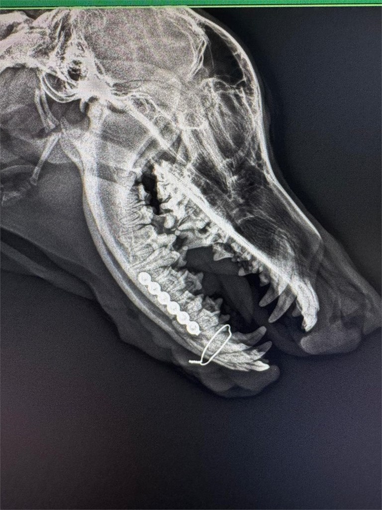 Fractura mandibular.