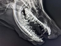 Fractura mandibular.