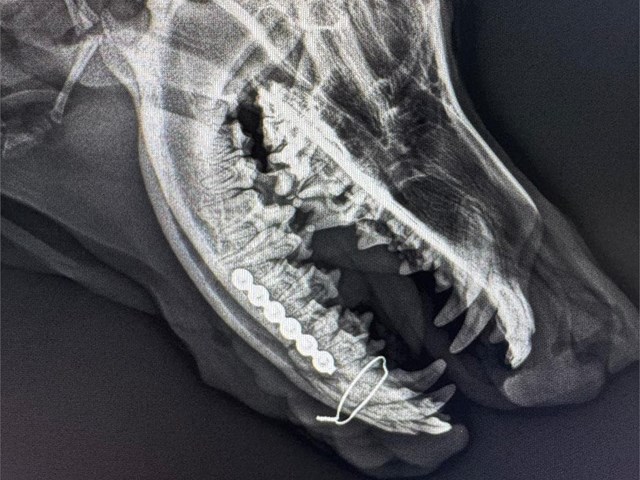 Fractura mandibular.